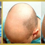 Démangeaisons après greffe de cheveux : comment réagir ?
