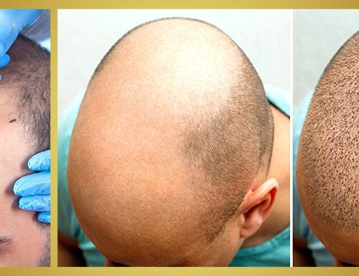 greffe de cheveux