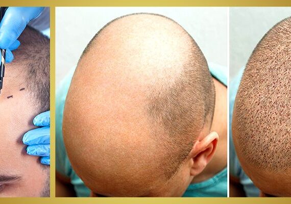 greffe de cheveux