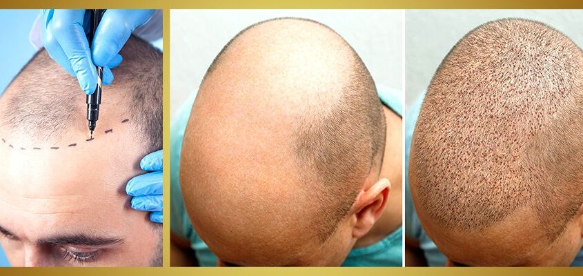 Démangeaisons après greffe de cheveux : comment réagir ?