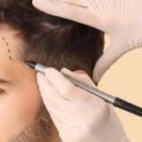 5 raisons de faire sa greffe de cheveux en Espagne