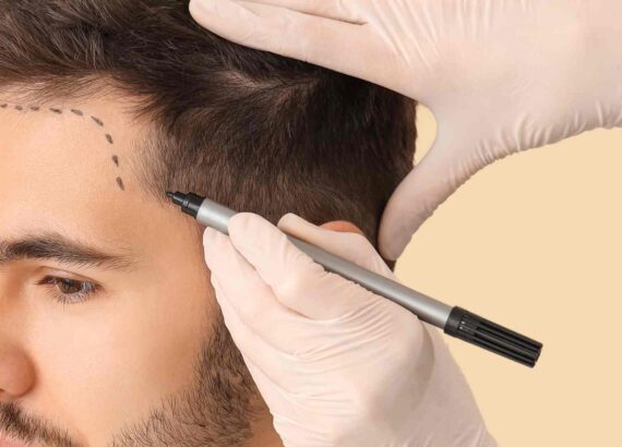 5 raisons de faire sa greffe de cheveux en Espagne