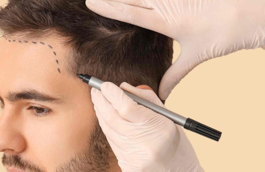 5 raisons de faire sa greffe de cheveux en Espagne